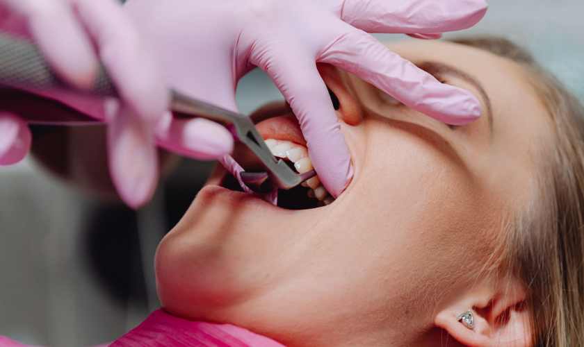 Manage Bleeding After Tooth Extraction