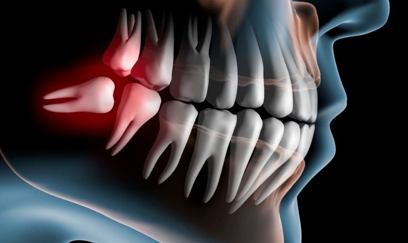 Wisdom Teeth
